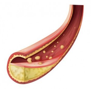 Illustration of an Artery blocked with cholesterol on a white background